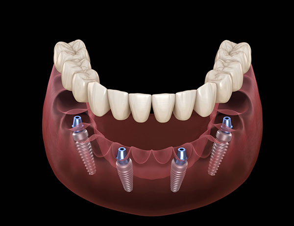 all-on-four-dental-implants-1 (1)