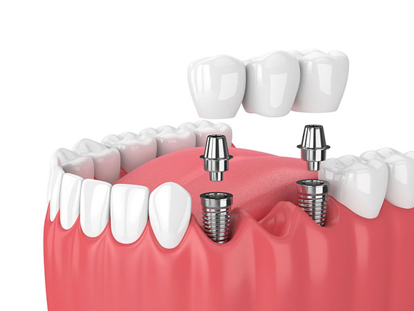 dental-implant-supported-bridge-1