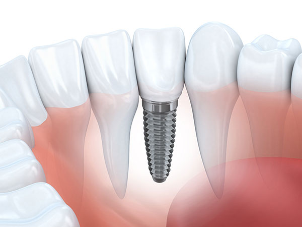 single-dental-implant