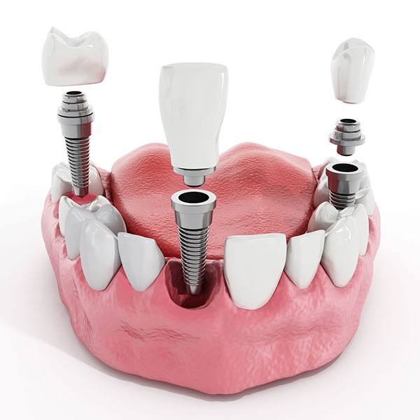 types-of-dental-implants-1